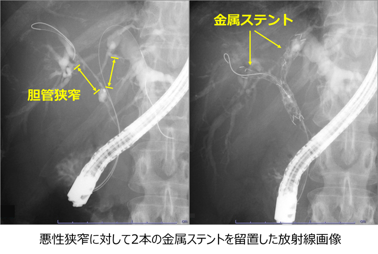 胆膵-l-4