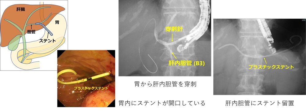 胆膵-o-1