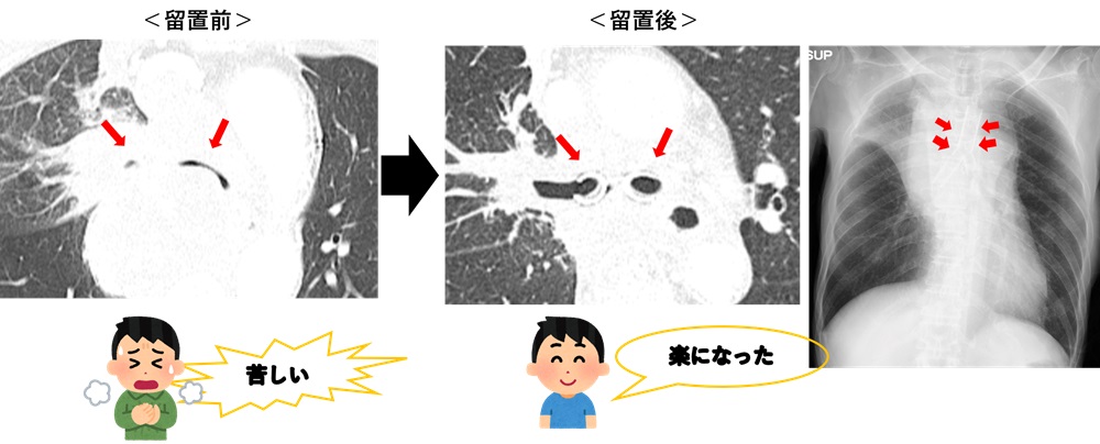 呼吸器-v-1