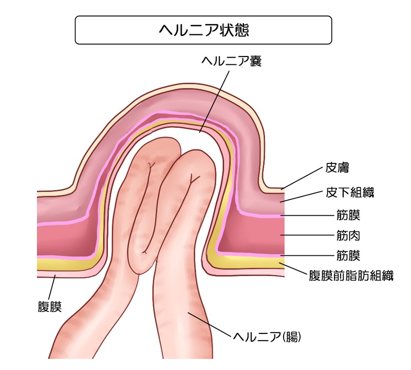ヘルニア状態