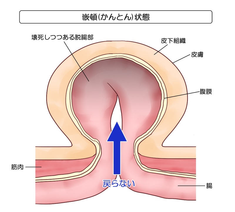 嵌頓状態