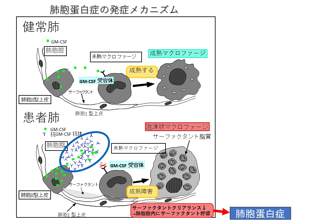 肺胞蛋白症の発症メカニズム