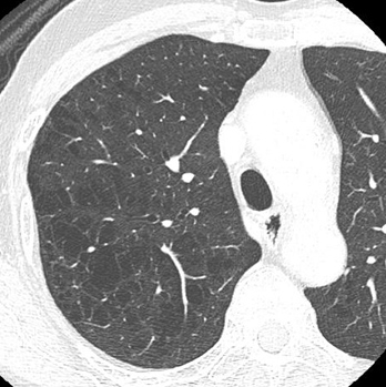 COPD01