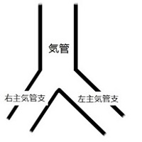 ステントー1