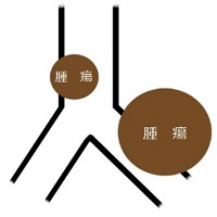 ステントー2