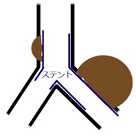 ステントー4
