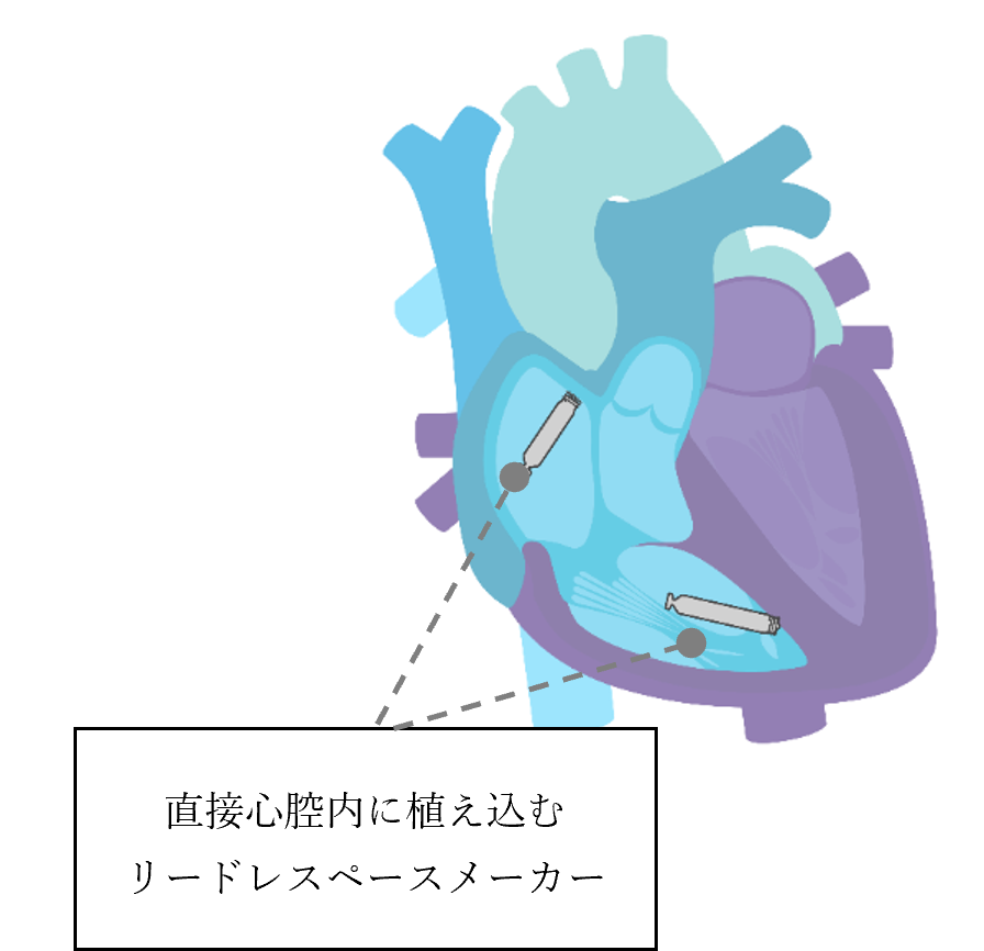 リードレスペースメーカ