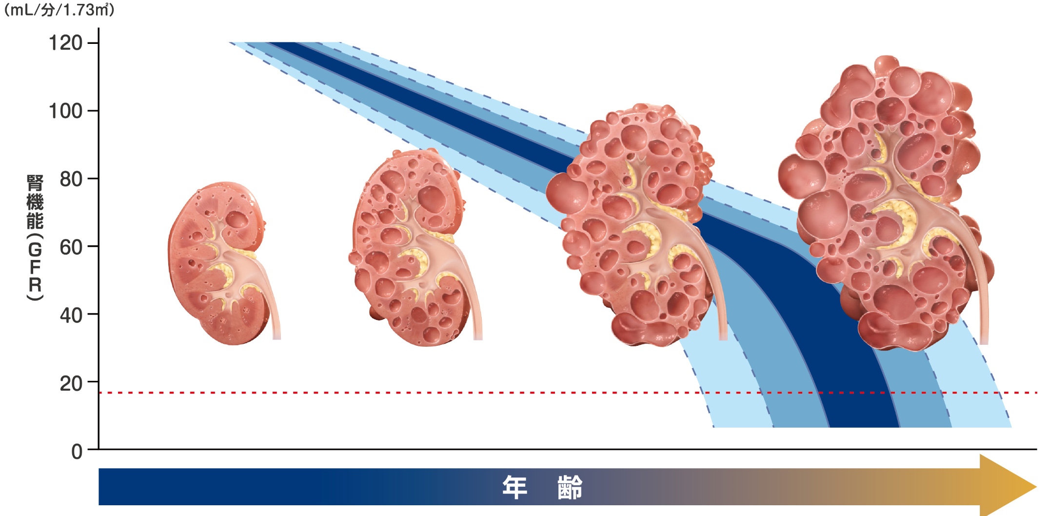 adpkd