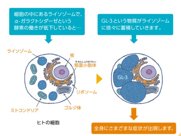 ファブリー病