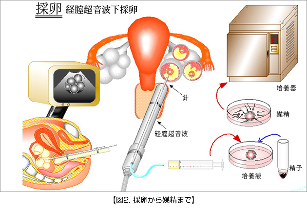 体外受精2