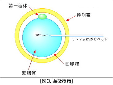 顕微授精