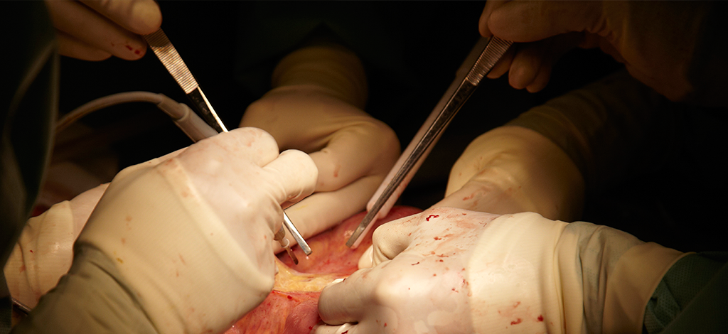 pseudomyxoma.png