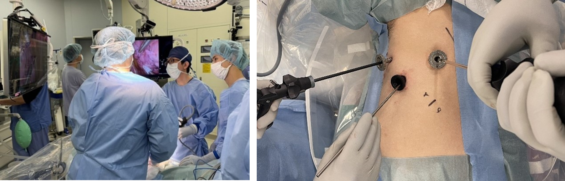 胸腔鏡下手術の実際