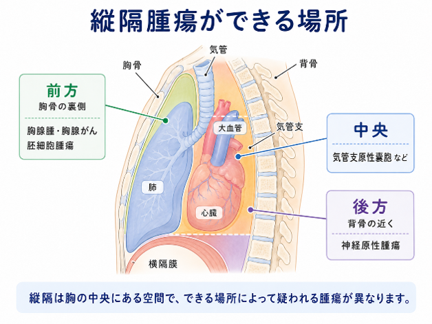 縦隔腫瘍ができる場所