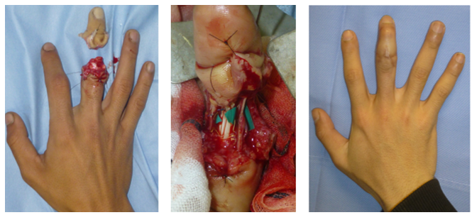 切断組織再接着・欠損組織再建_2