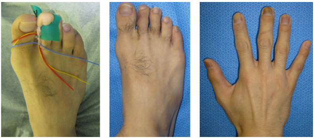 切断組織再接着・欠損組織再建_4