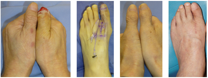 切断組織再接着・欠損組織再建_5