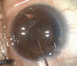 cataractiol.gif