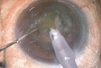 cataractpea.gif