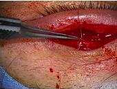 lidsurgery1.jpeg