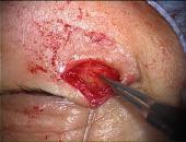 lidsurgery2.jpeg