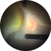 rdvitrectomy.jpeg