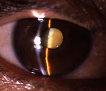 cataractslit1.jpeg