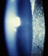 cataractslit2.jpeg