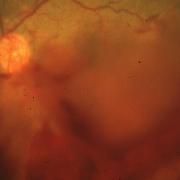 vhretinoschisis.jpeg