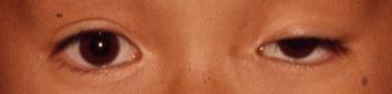ptosis1.jpeg