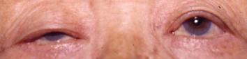 ptosis2.jpeg