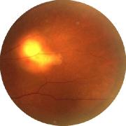 tuberculoma.jpeg