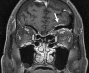 pachymeningitis.jpeg