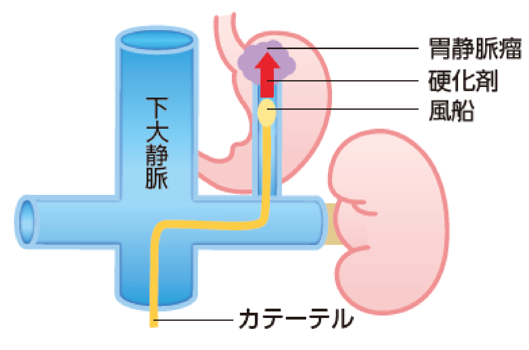 門脈圧亢進症に伴う合併症_fig_4