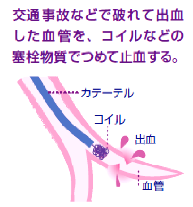 外傷性出血_fig_5