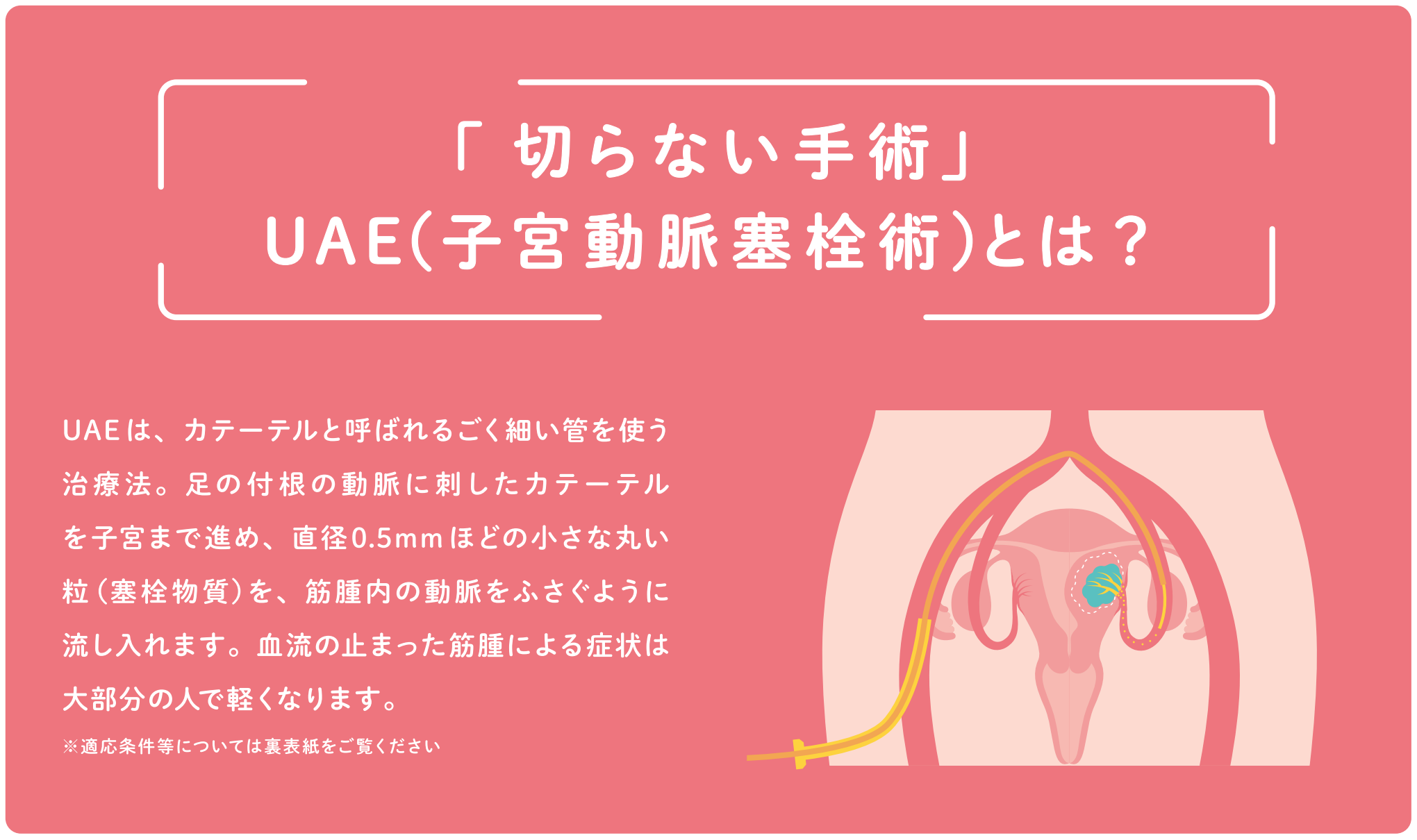 子宮筋腫_fig_6