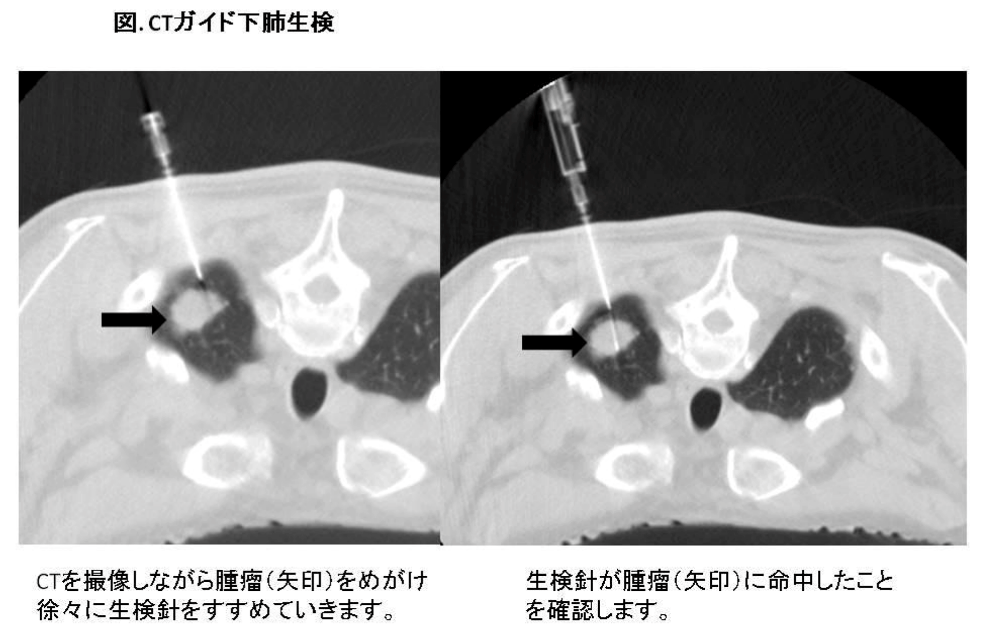 画像ガイド下生検_fig_9