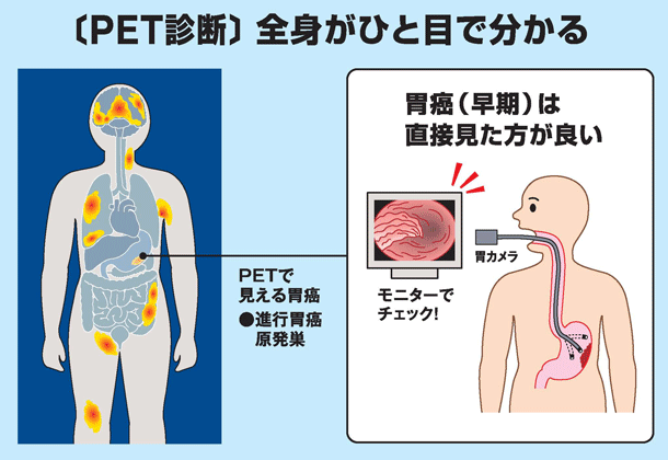 「PET診断」全身がひと目で分かる