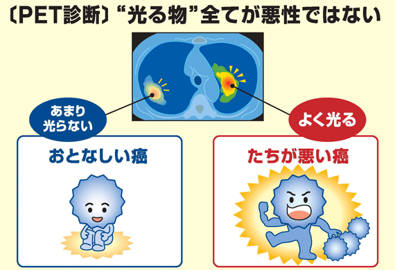 「PET診断」”光る物”全てが悪性ではない