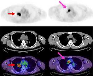 横断像は上から順にPET白黒像、CT、PET−CT融合像（カラー）