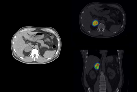 SPECT/CT (Discovery 670DR)による画像（副腎シンチグラフィー）