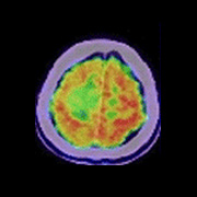 PET-CT